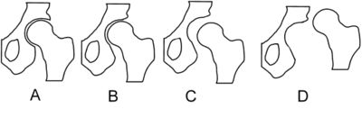 X-Ray Image of Hips